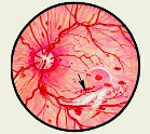 diabetic retinopathy1